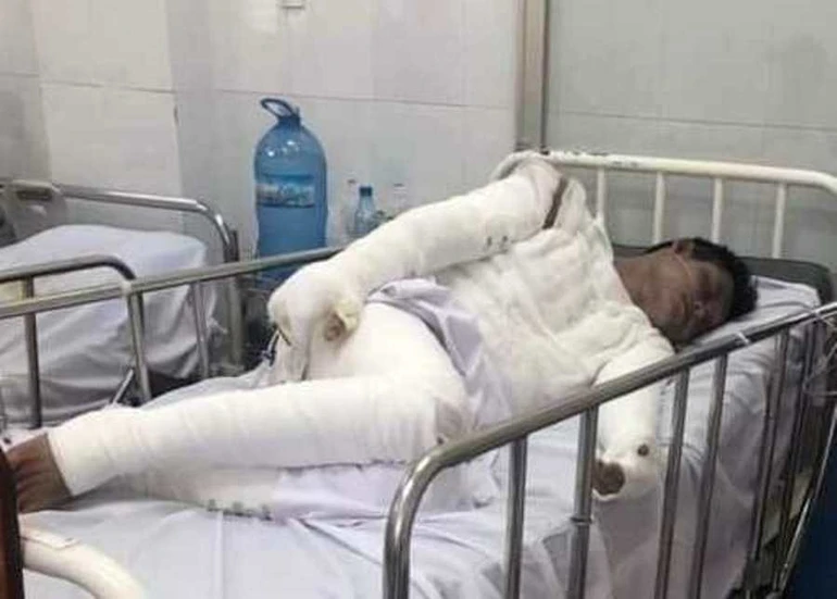 Thanh niên bị phỏng toàn thân cần giúp đỡ